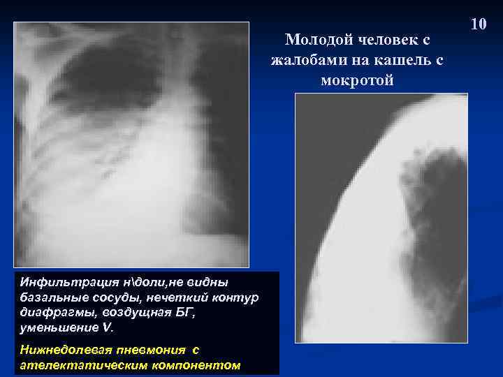 Молодой человек с жалобами на кашель с мокротой Инфильтрация ндоли, не видны базальные сосуды,
