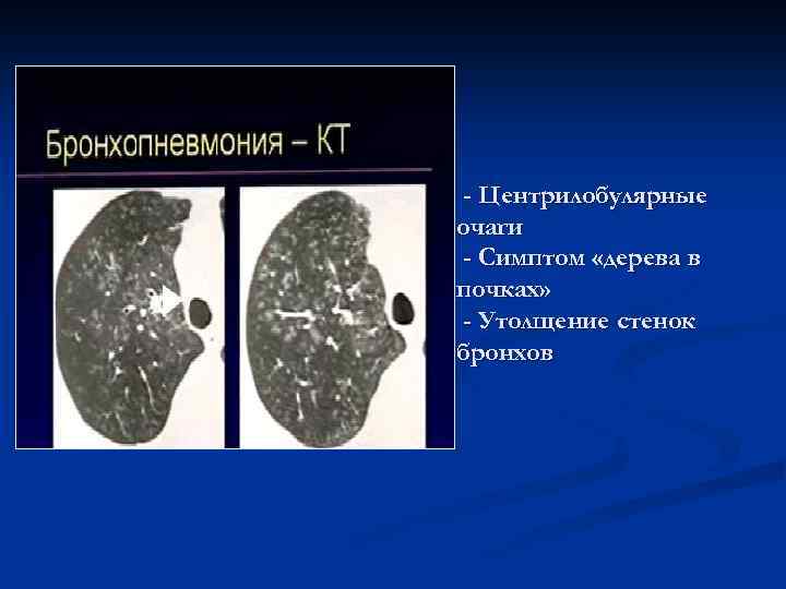 Бронхопневмония кт картина