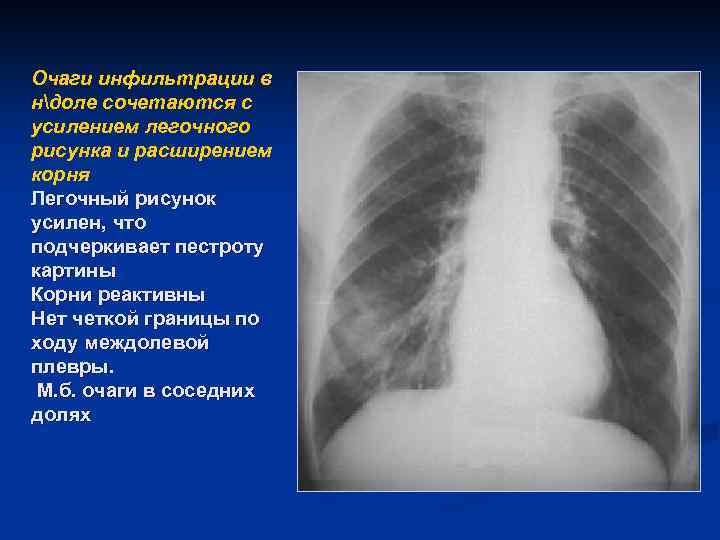 Отделы легочного рисунка. Легочный рисунок усилен. Усиленный легочный рисунок. Легочный рисунок обогащен. Усиление легочного рисунка.