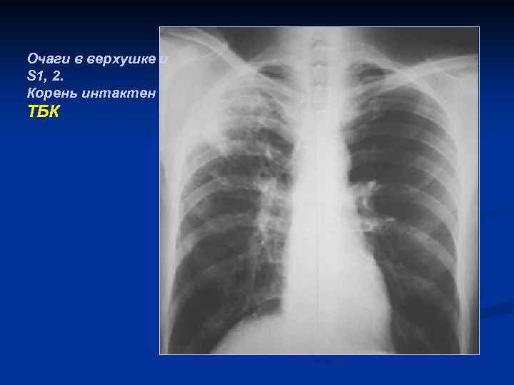 Очаги в верхушке и S 1, 2. Корень интактен ТБК 