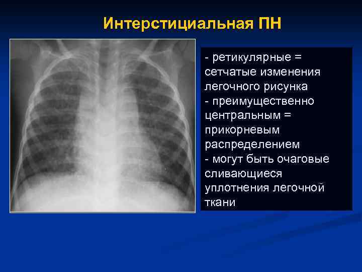 Обогащение легочного рисунка. Интерстициальная пневмония рентген. Ретикулярные изменения на рентгенограмме легких. Ретикулярные изменения в легких рентген. Легочный рисунок усилен за счет интерстициального компонента.