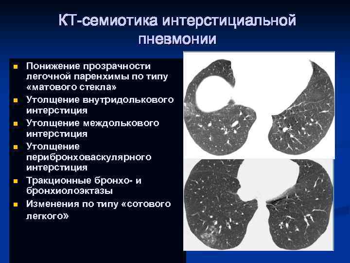 Полисегментарная пневмония карта вызова