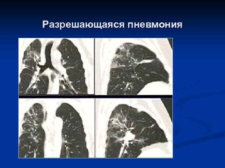 Разрешающаяся пневмония 