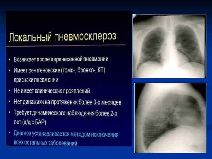 Картина кт картина пневмосклероза