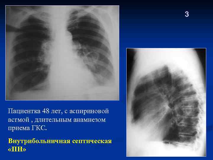 3 Пациентка 48 лет, с аспириновой астмой , длительным анамнезом приема ГКС. Внутрибольничная септическая