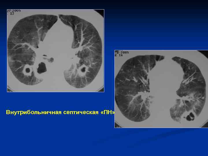 Внутрибольничная септическая «ПН» 