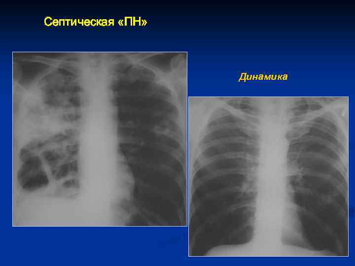 Септическая «ПН» Динамика 
