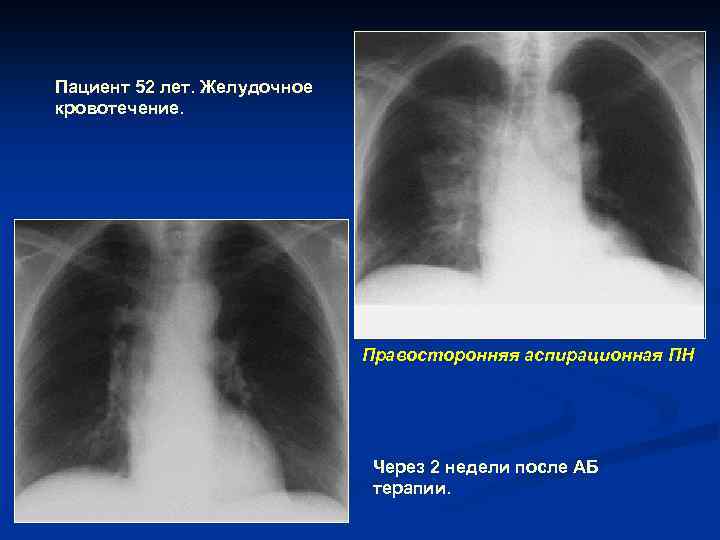 Пациент 52 лет. Желудочное кровотечение. Правосторонняя аспирационная ПН Через 2 недели после АБ терапии.