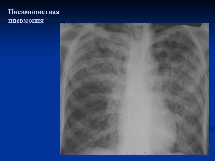 Пневмоцистная пневмония 
