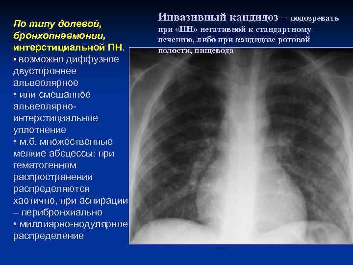 По типу долевой, бронхопневмонии, интерстициальной ПН. • возможно диффузное двустороннее альвеолярное • или смешанное