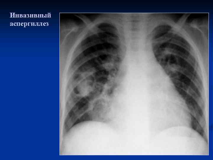Инвазивный аспергиллез 