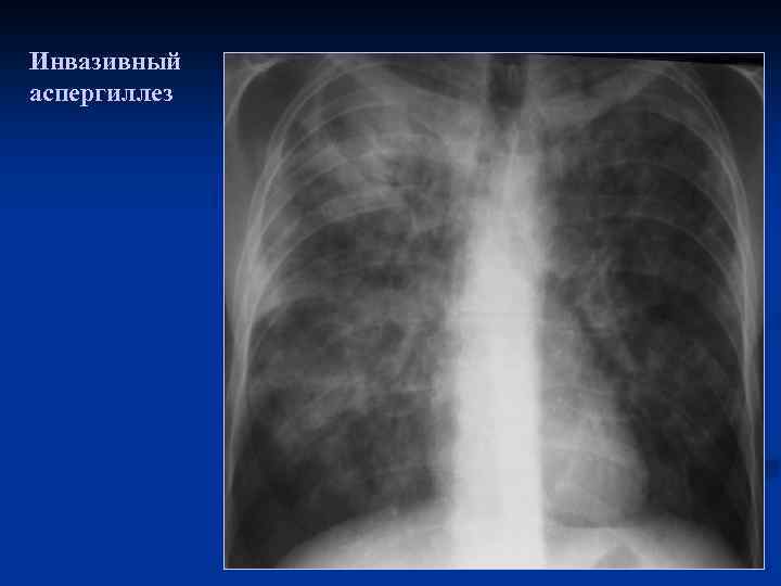 Инвазивный аспергиллез 