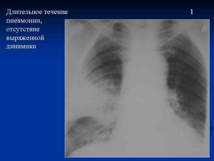 Длительное течение пневмонии, отсутствие выраженной динамики 1 
