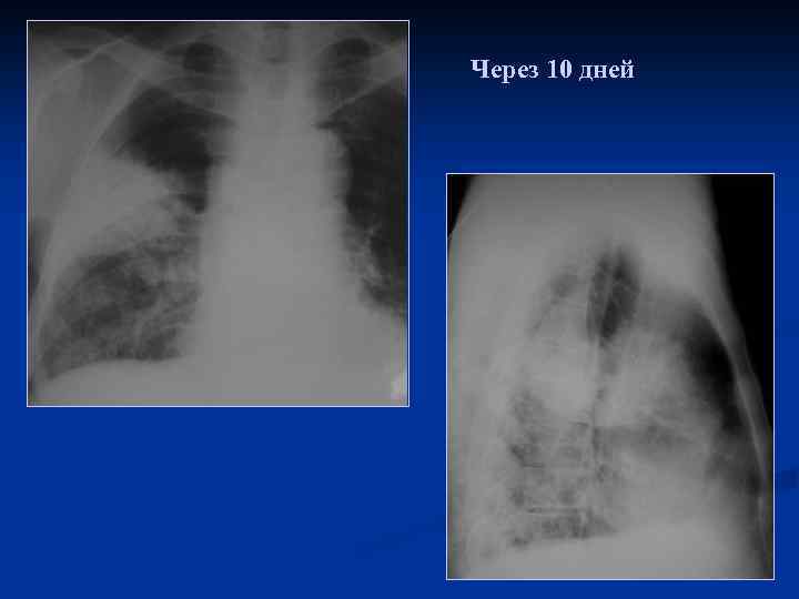 Через 10 дней 