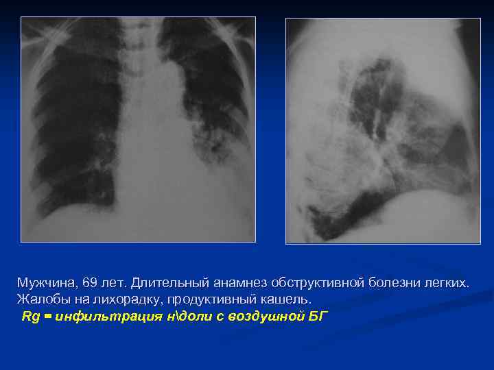 Мужчина, 69 лет. Длительный анамнез обструктивной болезни легких. Жалобы на лихорадку, продуктивный кашель. Rg