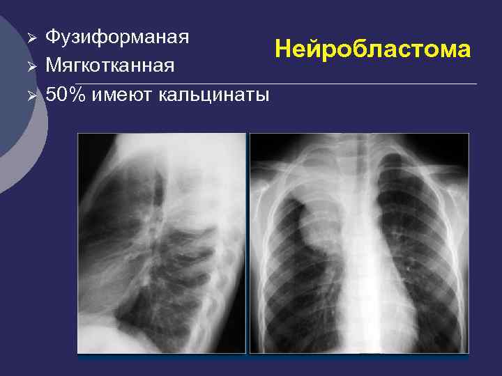 Мягкотканное образование в легком на кт. Нейробластома грудной клетки. Нейробластома рентгенограмма средостения. Нейробластома заднего средостения. Нейробластома средостения кт.