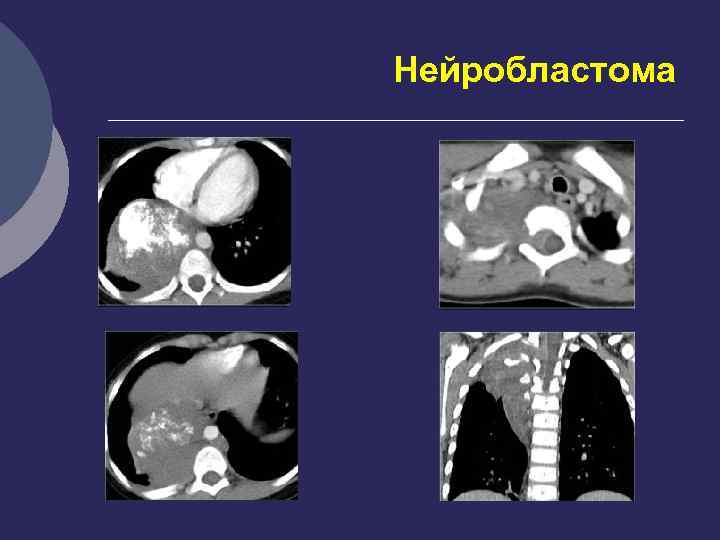 Нейробластома у детей презентация