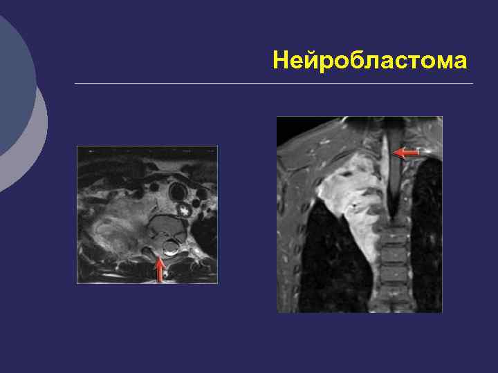 Нейробластома у детей презентация