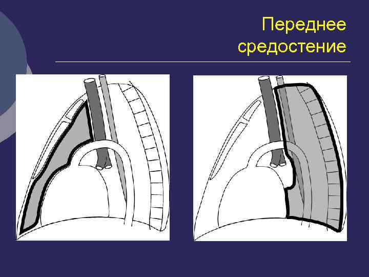 Топографическая анатомия переднего и заднего средостения презентация