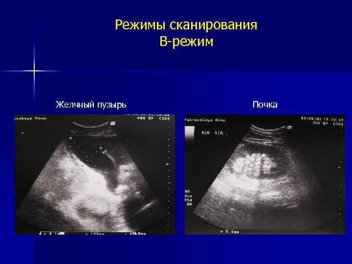 Режимы сканирования B-режим Желчный пузырь Почка 