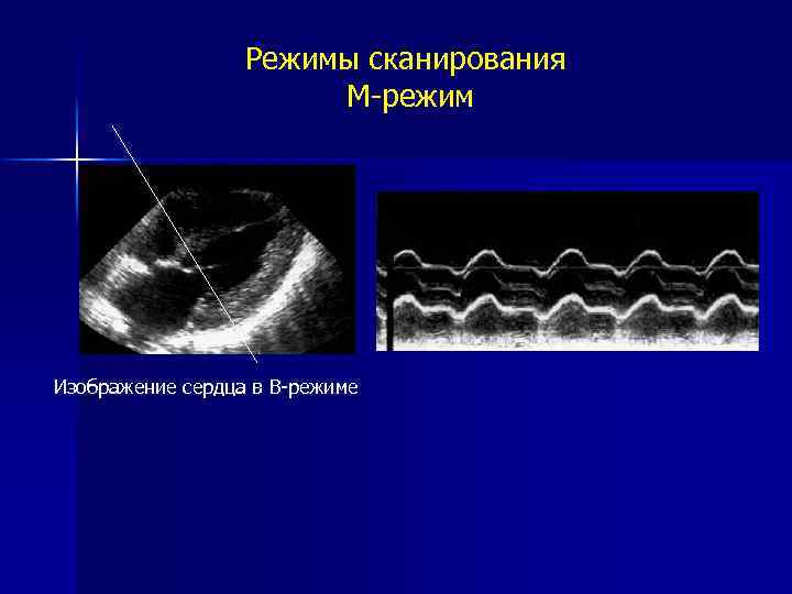 Режимы сканирования M-режим Изображение сердца в B-режиме 