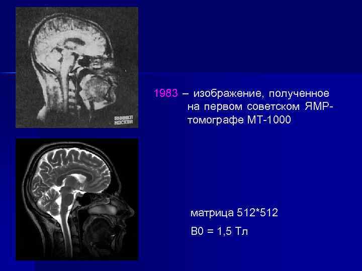 1983 – изображение, полученное на первом советском ЯМРтомографе МТ-1000 матрица 512*512 B 0 =