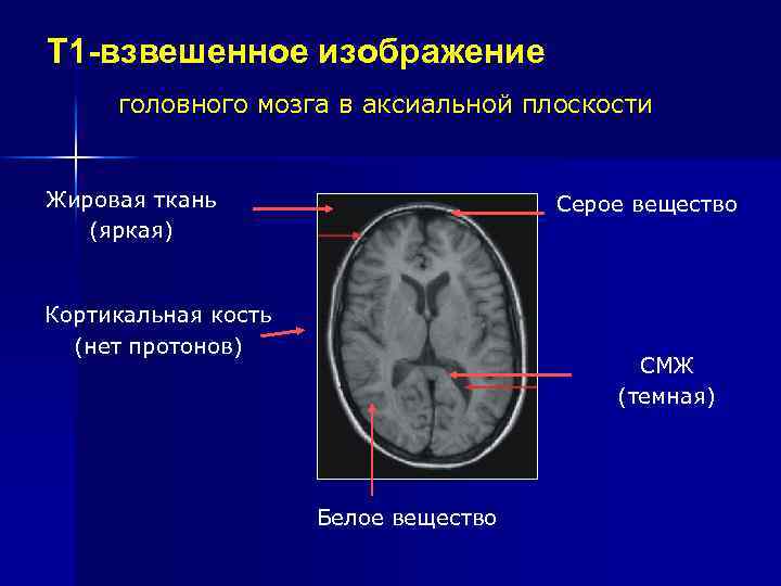 Т 1 -взвешенное изображение головного мозга в аксиальной плоскости Жировая ткань (яркая) Серое вещество