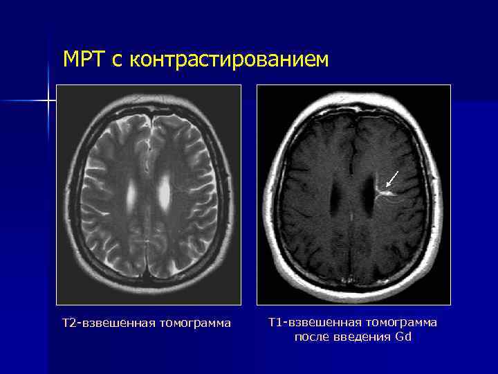 МРТ с контрастированием Т 2 -взвешенная томограмма Т 1 -взвешенная томограмма после введения Gd