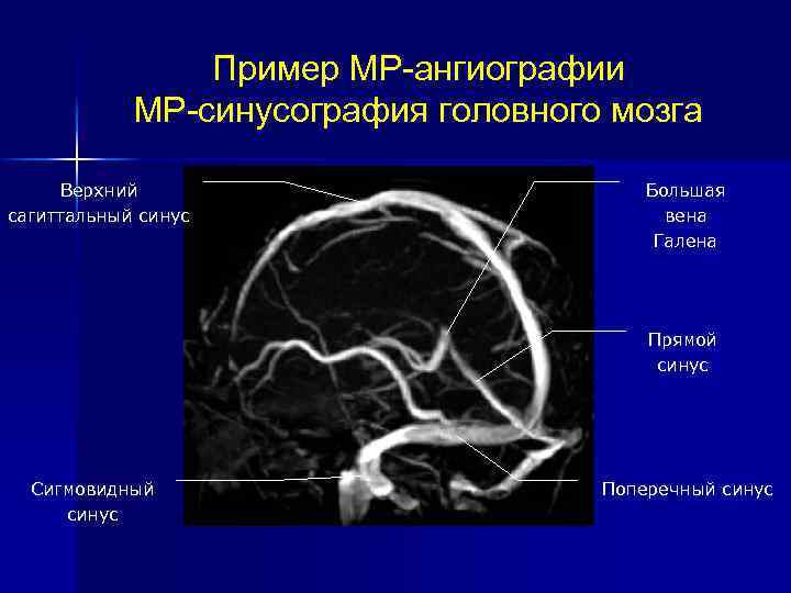 Ангиография головного мозга