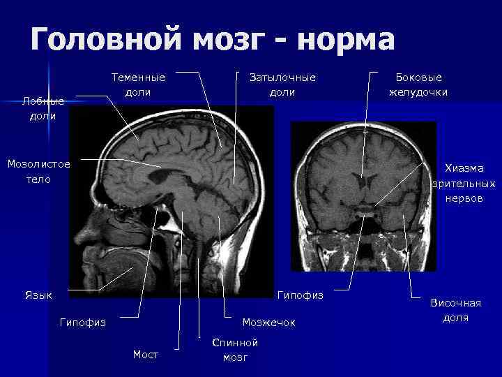 Головной мозг - норма Лобные доли Теменные доли Затылочные доли Мозолистое тело Боковые желудочки