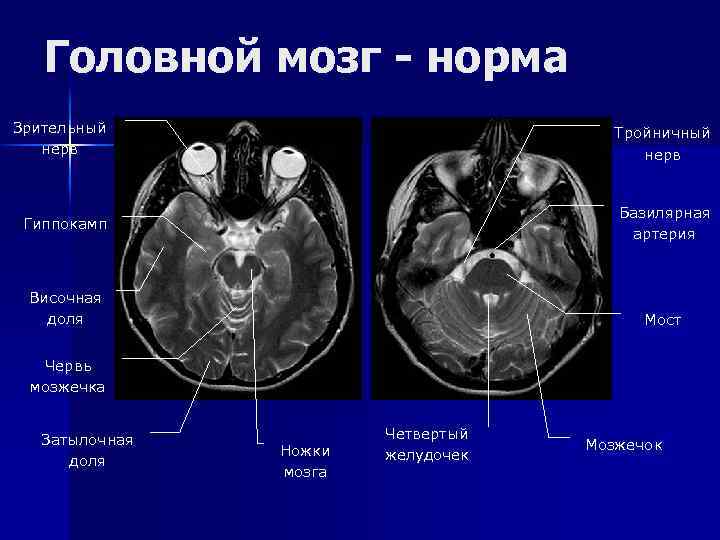 Головной мозг - норма Зрительный нерв Тройничный нерв Гиппокамп Базилярная артерия Височная доля Мост