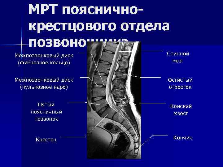МРТ поясничнокрестцового отдела позвоночника Межпозвонковый диск (фиброзное кольцо) Спинной мозг Межпозвонковый диск (пульпозное ядро)