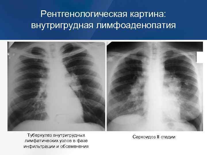 Увеличение лимфоузлов в легких причины. Туберкулез внутригрудных лимфатических узлов рентгенограмма. Туберкулез внутригрудных лимфатических узлов рентген. Туберкулез лимфатических узлов рентгенограмма. Туберкулез внутригрудных узлов рентген.