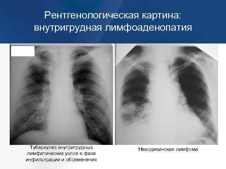 Ампутация корней легких при рентгенологической картине характерна для