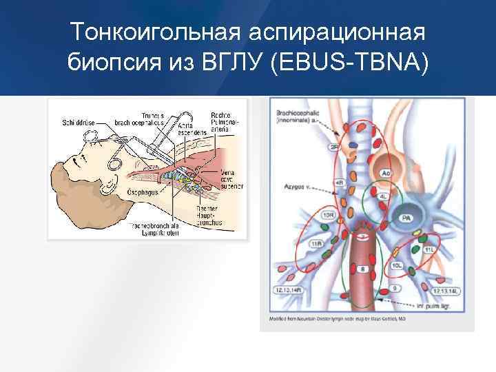 Внутригрудные лимфатические узлы