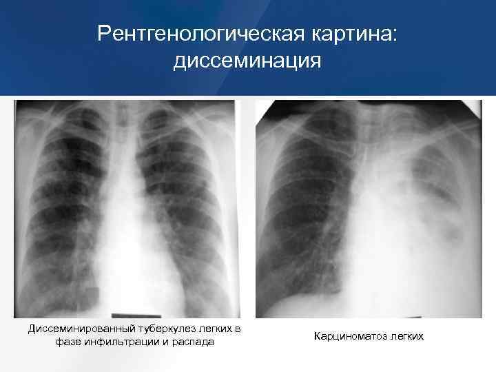 Инфильтративный легкого в фазе распада. Милиарный диссеминированный туберкулез рентген. Инфильтративный туберкулез рентген. Диссеминированный туберкулёз лёгких рентген. Инфильтративный диссеминированный туберкулез рентген.
