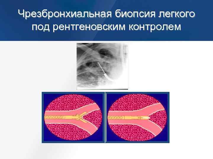Как делают биопсию легких