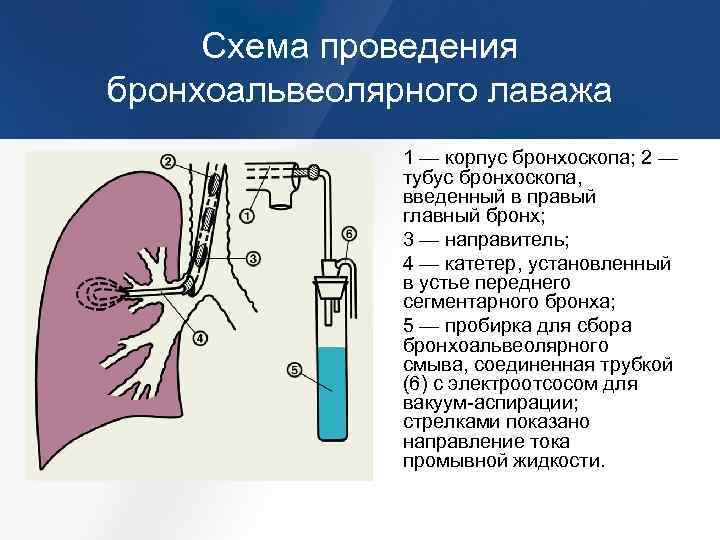 Биопсия легких как проводится