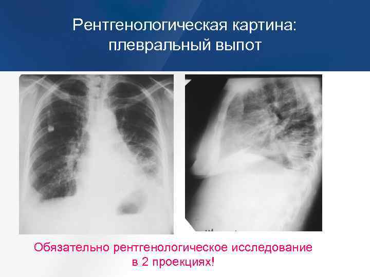 Сухой плеврит рентгенологическая картина