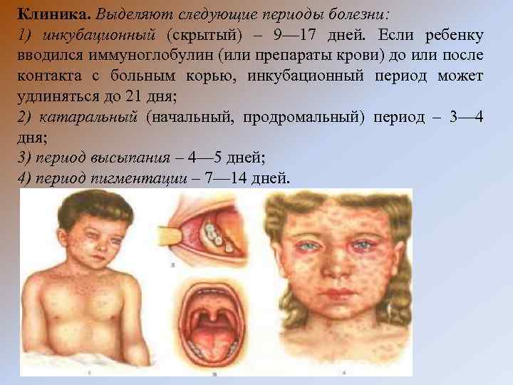 Клиника. Выделяют следующие периоды болезни: 1) инкубационный (скрытый) – 9— 17 дней. Если ребенку