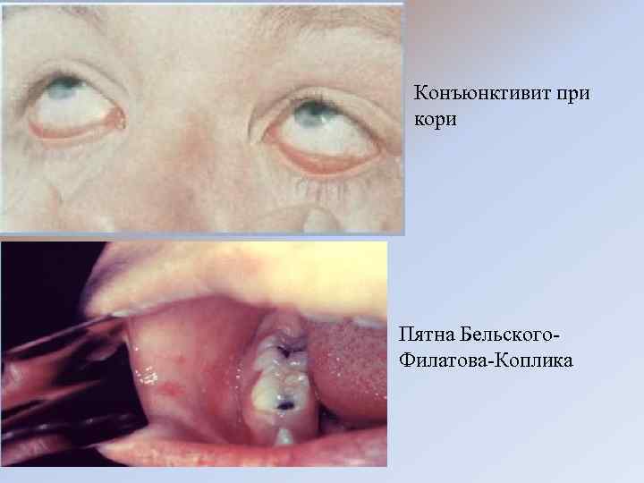 Конъюнктивит при кори Пятна Бельского- Филатова-Коплика 