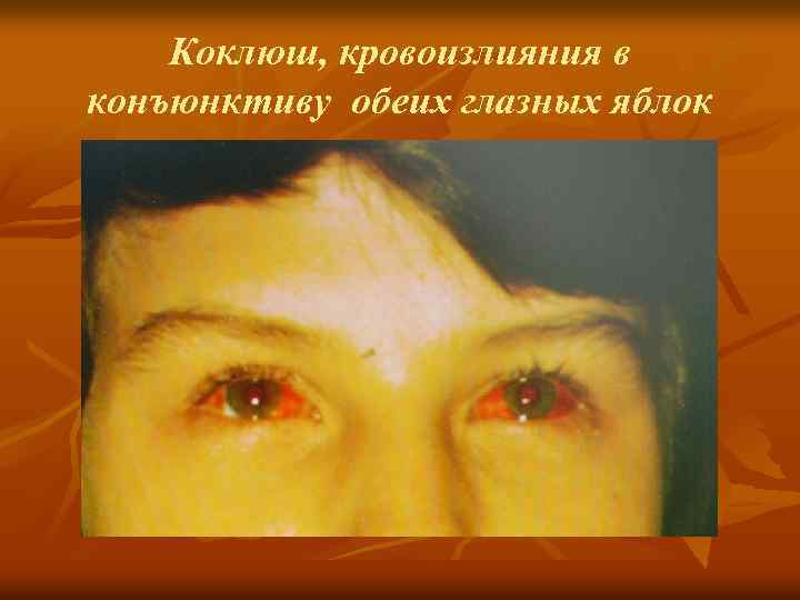 Коклюш, кровоизлияния в конъюнктиву обеих глазных яблок 