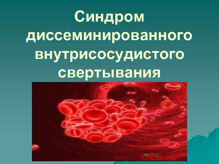 Синдром диссеминированного внутрисосудистого свертывания 