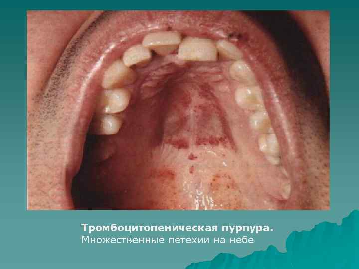 Тромбоцитопеническая пурпура. Множественные петехии на небе 
