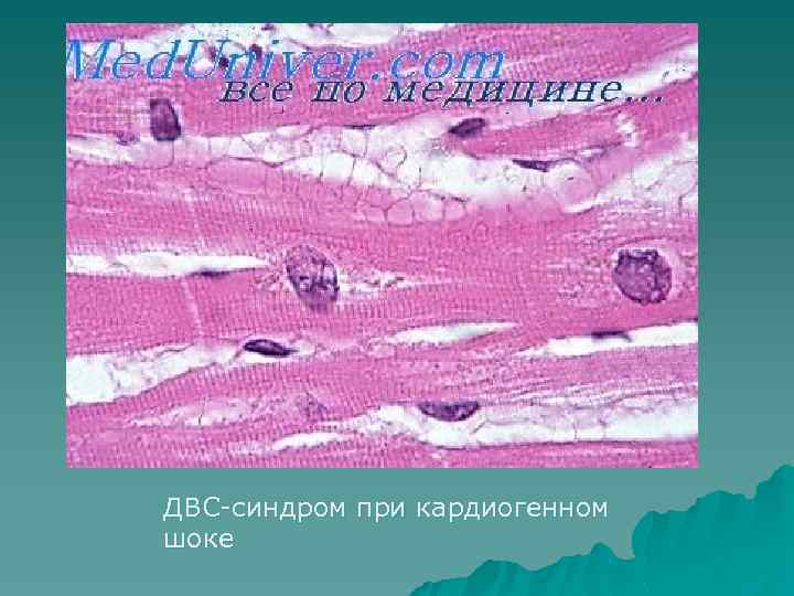 ДВС-синдром при кардиогенном шоке 