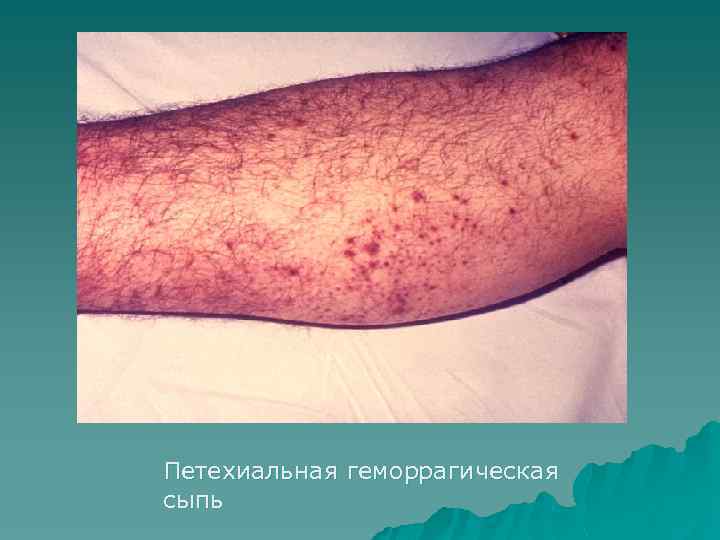 Петехиальная геморрагическая сыпь 