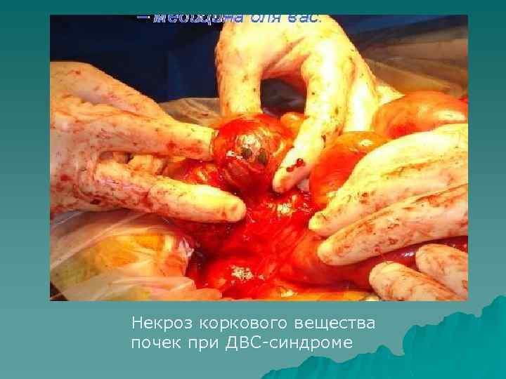 Некроз коркового вещества почек при ДВС-синдроме 