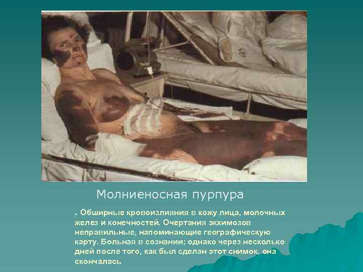 Молниеносная пурпура. Обширные кровоизлияния в кожу лица, молочных желез и конечностей. Очертания экхимозов неправильные,