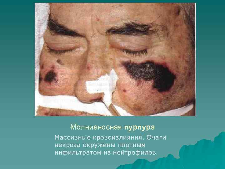 Молниеносная пурпура Массивные кровоизлияния. Очаги некроза окружены плотным инфильтратом из нейтрофилов. 