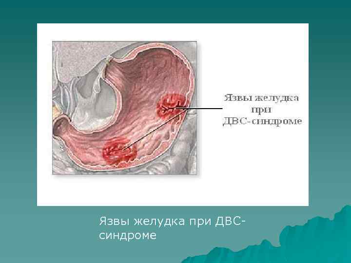 Язвы желудка при ДВСсиндроме 